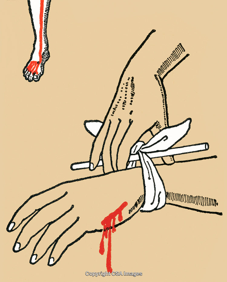 Illustration Demonstrating Application of Tourniquet Technique on an Injured Arm