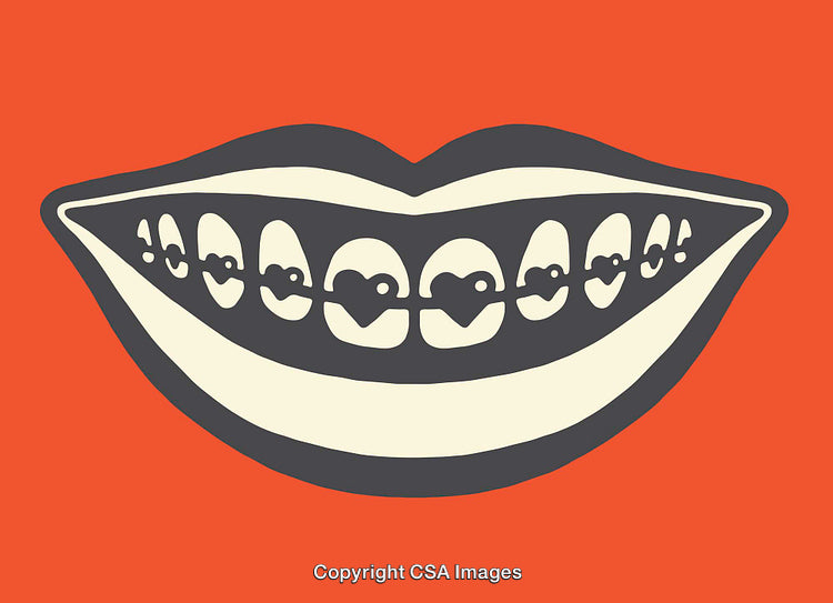 Illustration of a Smiling Mouth with Braces in Bold Graphic Art Style