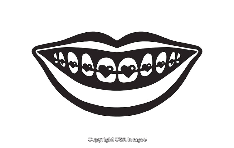 Black and White Line Art of a Smiling Mouth with Braces